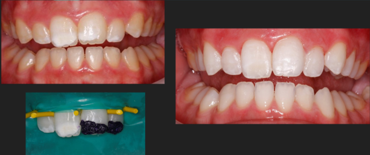 Microabrasion - before and after